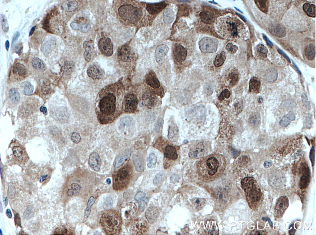 Immunohistochemistry (IHC) staining of human lung cancer tissue using PBK Polyclonal antibody (16110-1-AP)