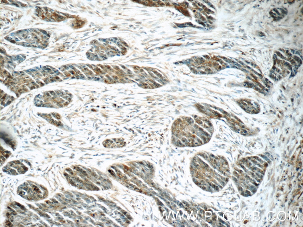 Immunohistochemistry (IHC) staining of human skin cancer tissue using PBK Polyclonal antibody (16110-1-AP)