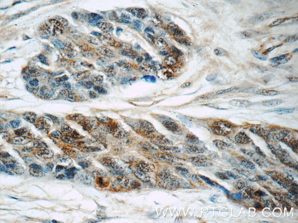 Immunohistochemistry (IHC) staining of human skin cancer tissue using PBK Polyclonal antibody (16110-1-AP)