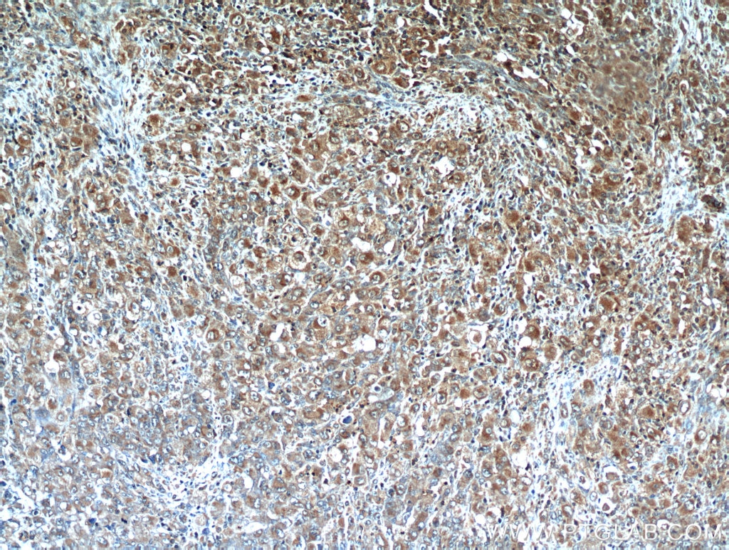 Immunohistochemistry (IHC) staining of human lymphoma tissue using CD43 Polyclonal antibody (13959-1-AP)
