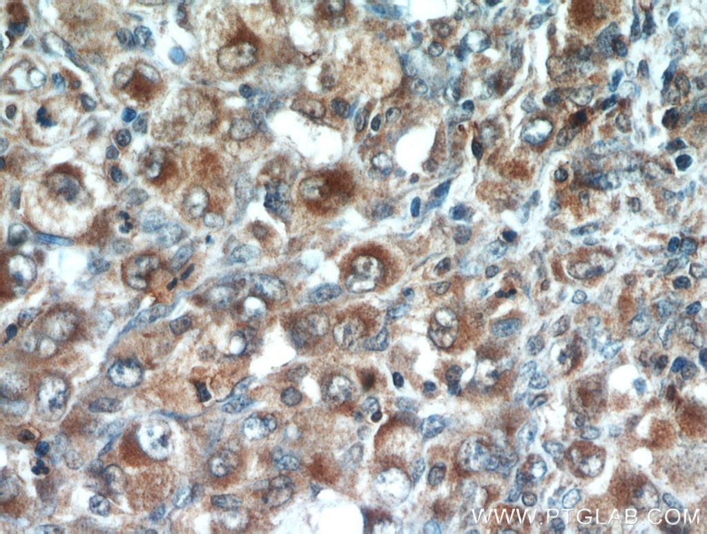 Immunohistochemistry (IHC) staining of human lymphoma tissue using CD43 Polyclonal antibody (13959-1-AP)