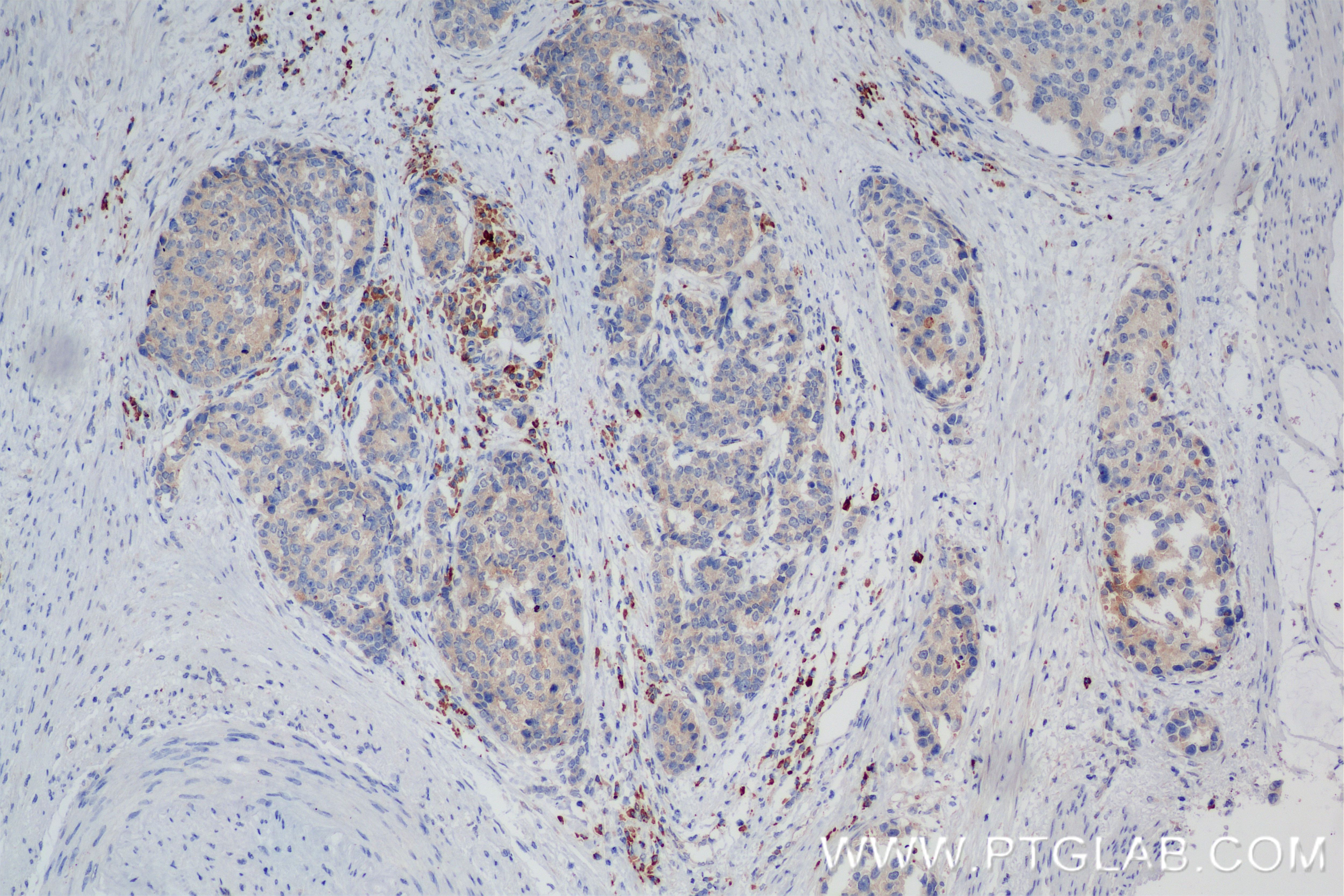 Immunohistochemistry (IHC) staining of human stomach cancer tissue using SPOCK1 Recombinant antibody (84977-1-RR)