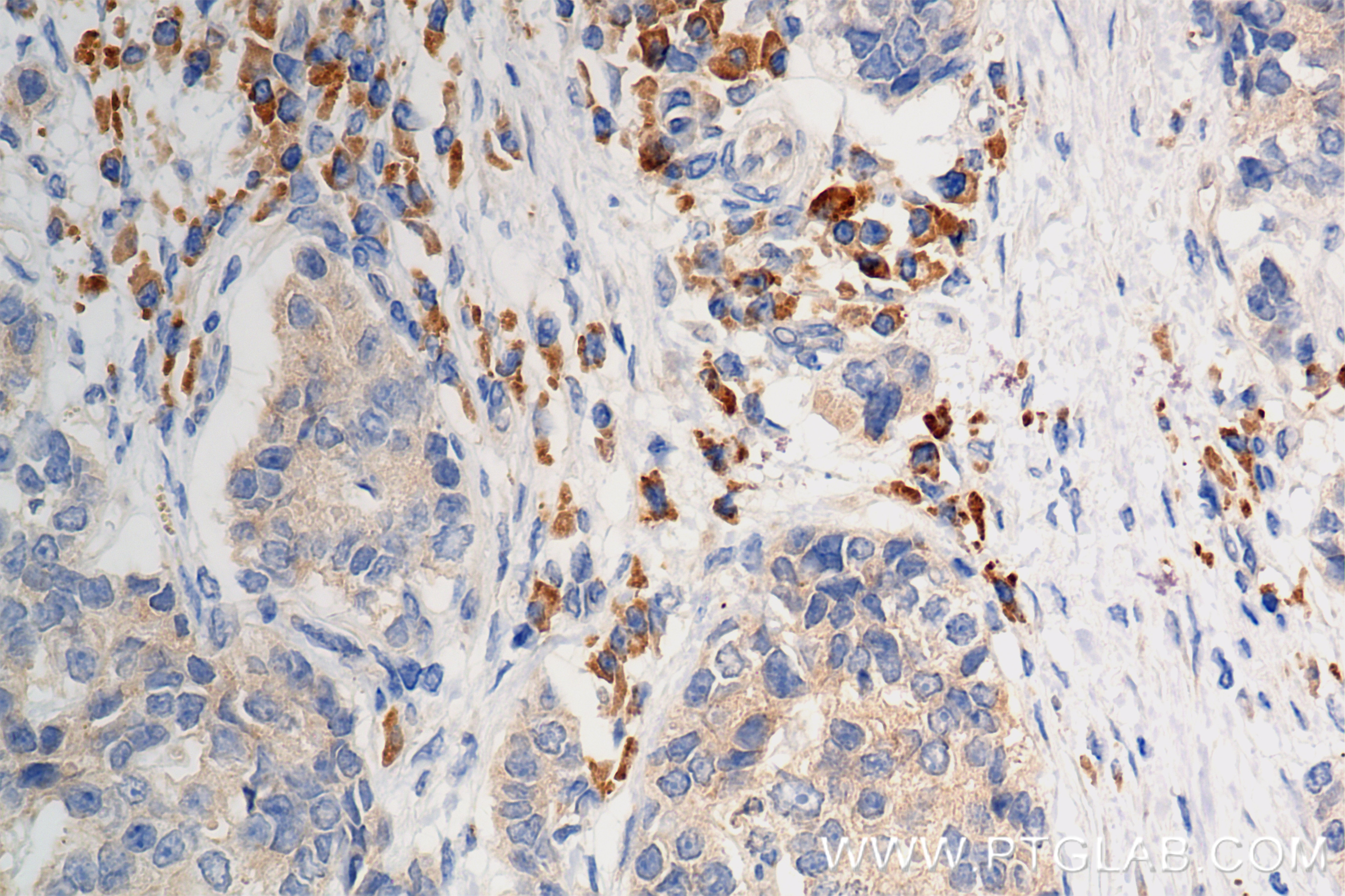 Immunohistochemistry (IHC) staining of human stomach cancer tissue using SPOCK1 Recombinant antibody (84977-1-RR)