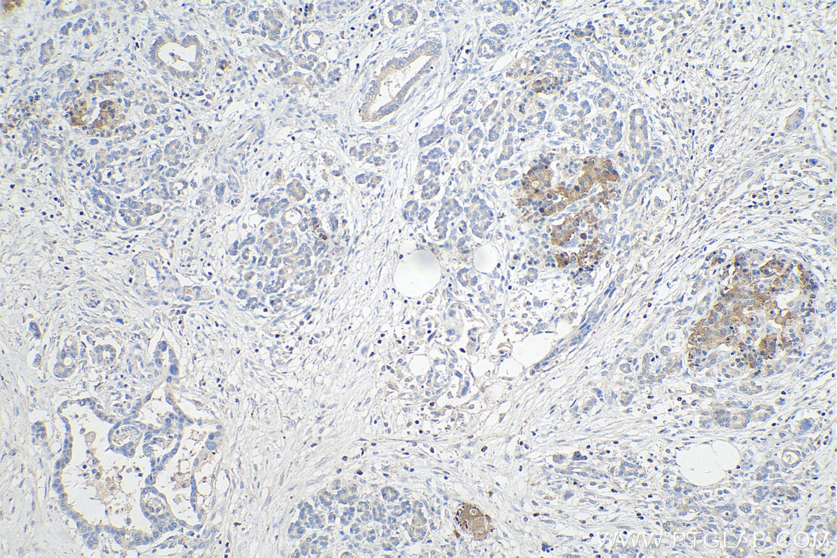 Immunohistochemistry (IHC) staining of human pancreas cancer tissue using SPOCK2 Polyclonal antibody (11725-1-AP)