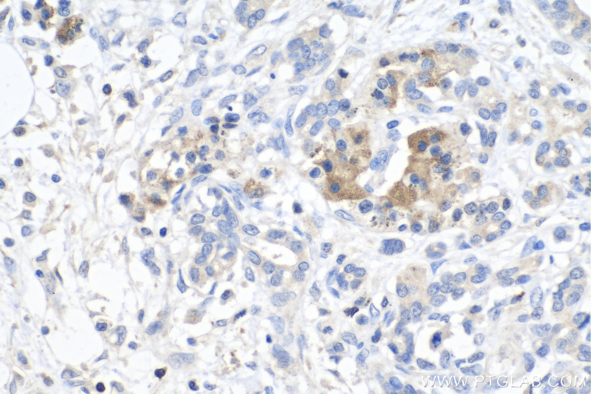 IHC staining of human pancreas cancer using 11725-1-AP