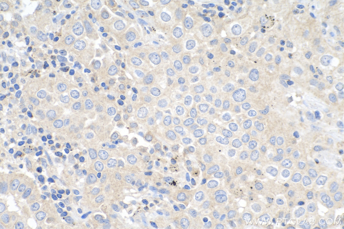 Immunohistochemistry (IHC) staining of human lung cancer tissue using SPOCK2 Polyclonal antibody (11725-1-AP)