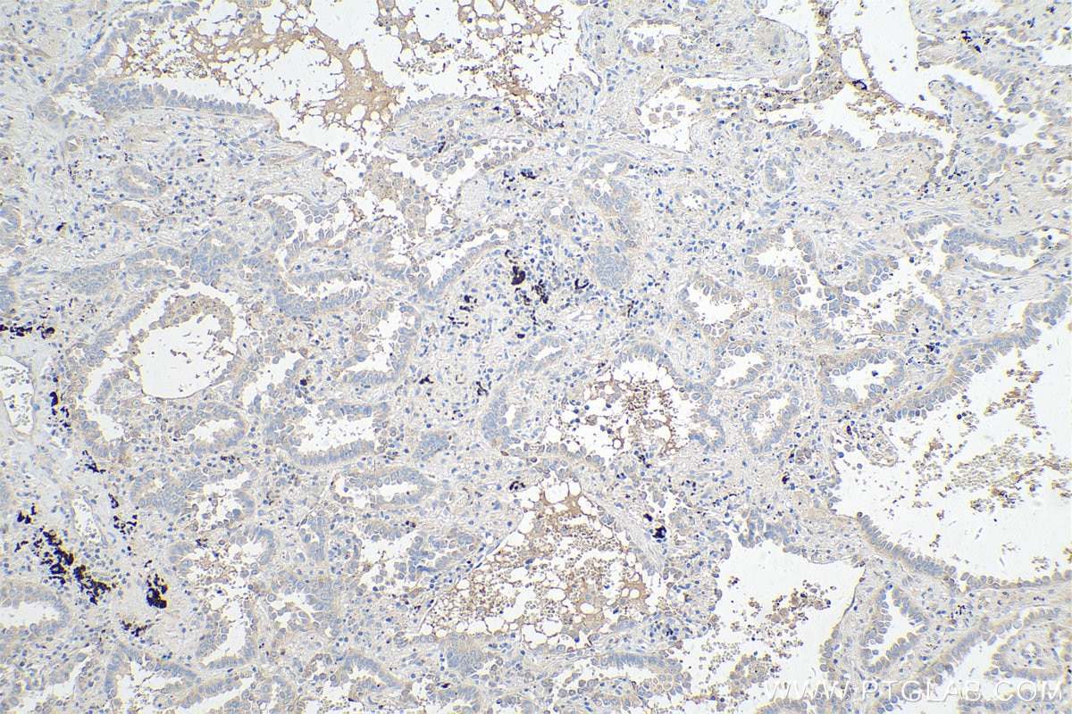 Immunohistochemistry (IHC) staining of human lung cancer tissue using SPOCK2 Polyclonal antibody (11725-1-AP)
