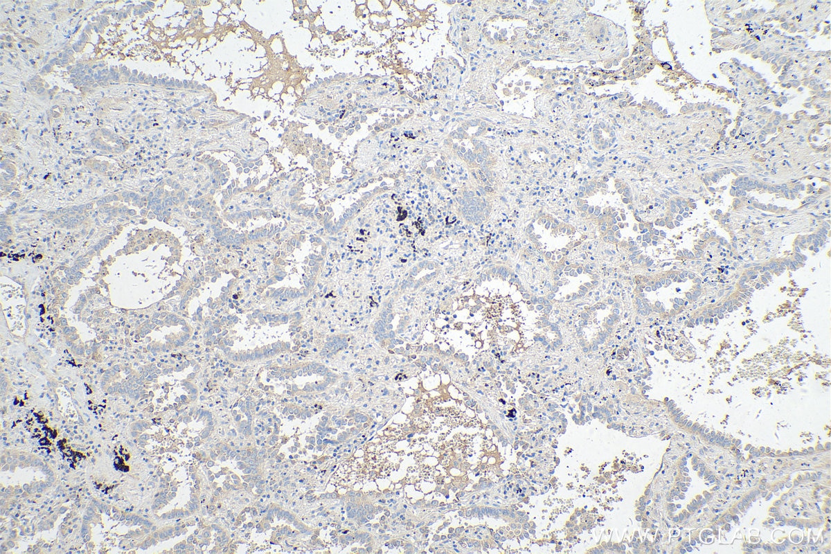 IHC staining of human lung cancer using 11725-1-AP