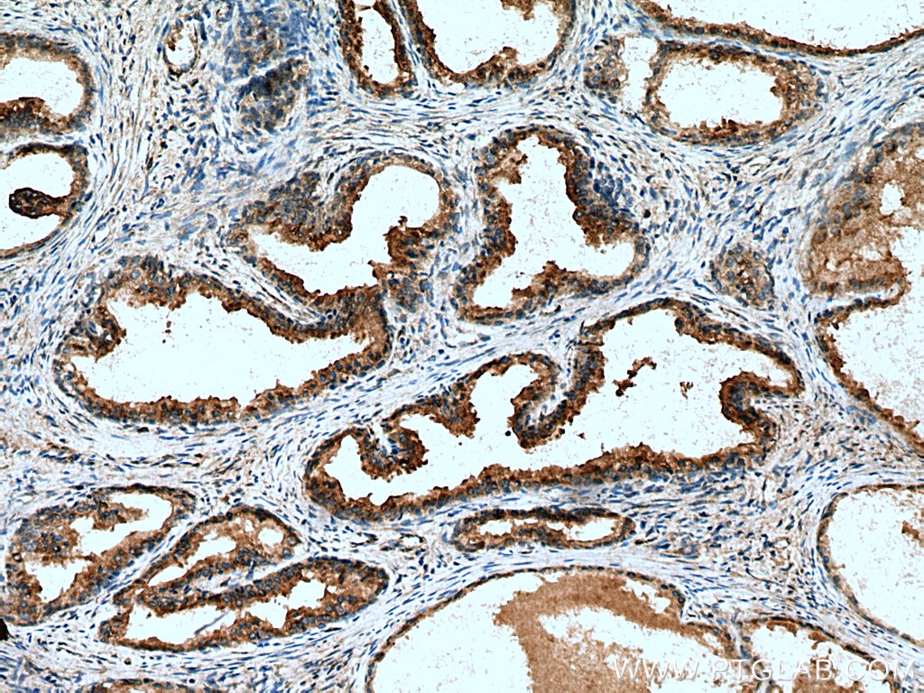 Immunohistochemistry (IHC) staining of human prostate cancer tissue using SPON2 Polyclonal antibody (20513-1-AP)