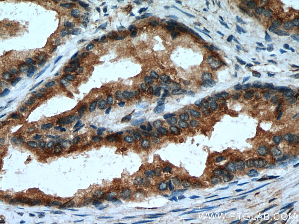 Immunohistochemistry (IHC) staining of human prostate cancer tissue using SPON2 Polyclonal antibody (20513-1-AP)