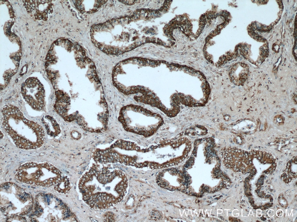 IHC staining of human prostate hyperplasia using 20513-1-AP