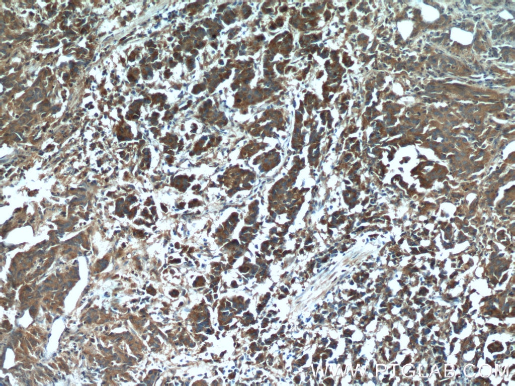 IHC staining of human prostate cancer using 20513-1-AP