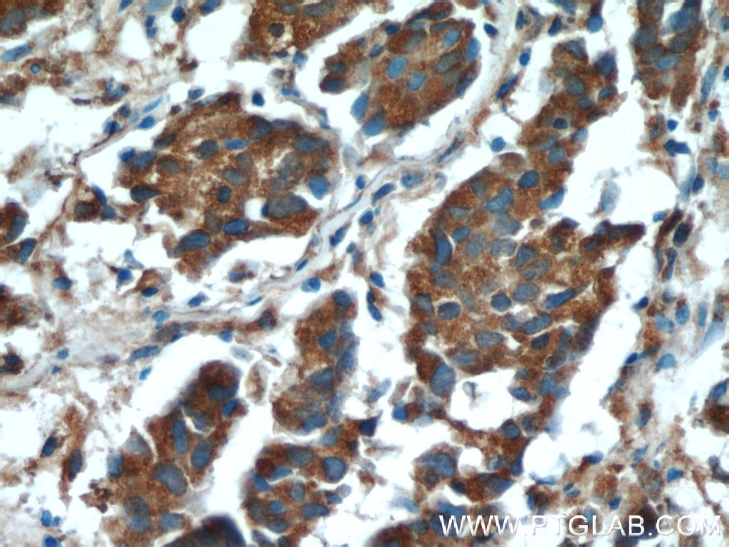 IHC staining of human prostate cancer using 20513-1-AP