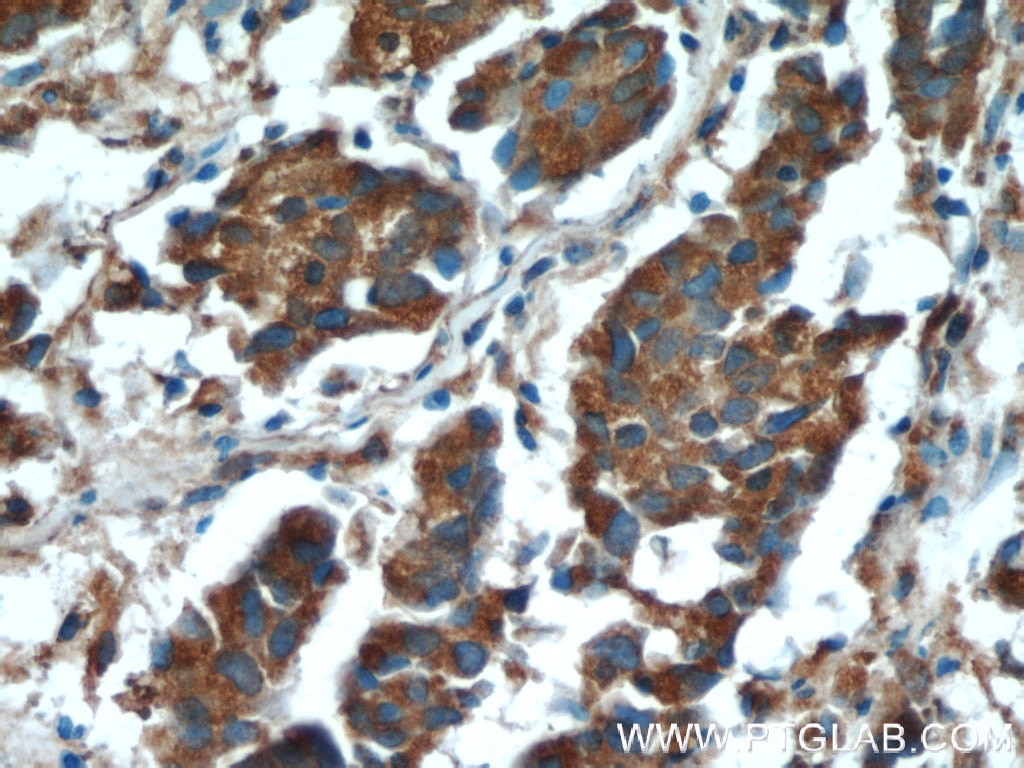 Immunohistochemistry (IHC) staining of human prostate cancer tissue using SPON2 Polyclonal antibody (20513-1-AP)