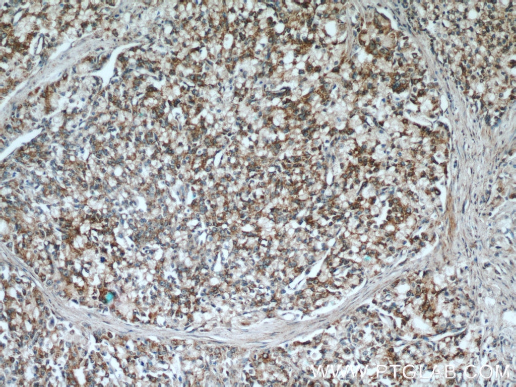 Immunohistochemistry (IHC) staining of human prostate cancer tissue using SPON2 Polyclonal antibody (20513-1-AP)