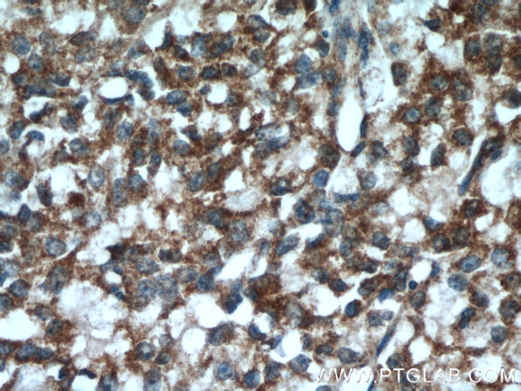 Immunohistochemistry (IHC) staining of human prostate cancer tissue using SPON2 Polyclonal antibody (20513-1-AP)