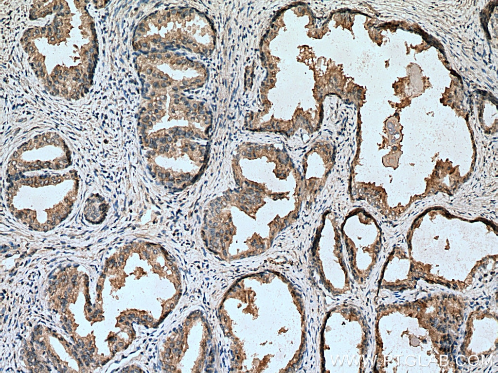 Immunohistochemistry (IHC) staining of human prostate cancer tissue using SPON2 Monoclonal antibody (66859-1-Ig)