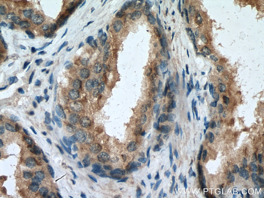 Immunohistochemistry (IHC) staining of human prostate cancer tissue using SPON2 Monoclonal antibody (66859-1-Ig)
