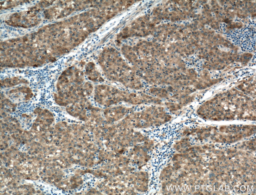 Immunohistochemistry (IHC) staining of human liver cancer tissue using SPR Polyclonal antibody (16822-1-AP)