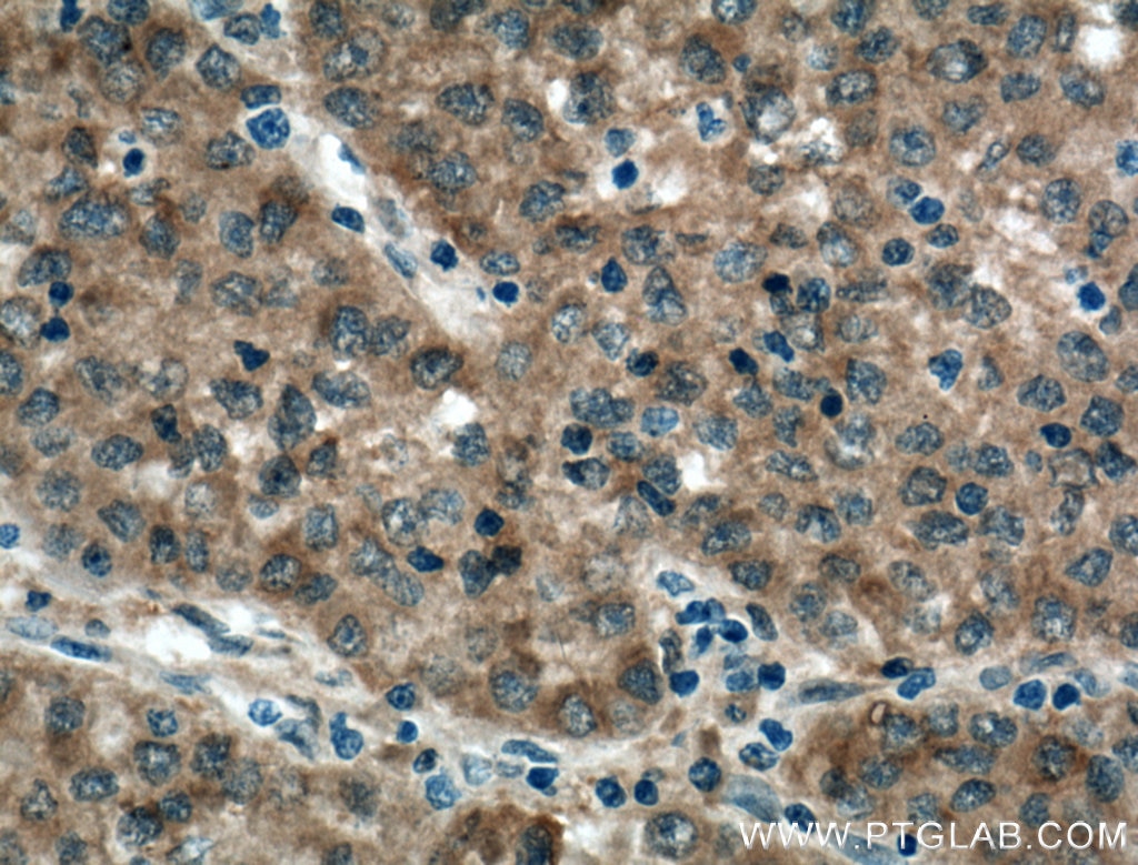 Immunohistochemistry (IHC) staining of human liver cancer tissue using SPR Polyclonal antibody (16822-1-AP)