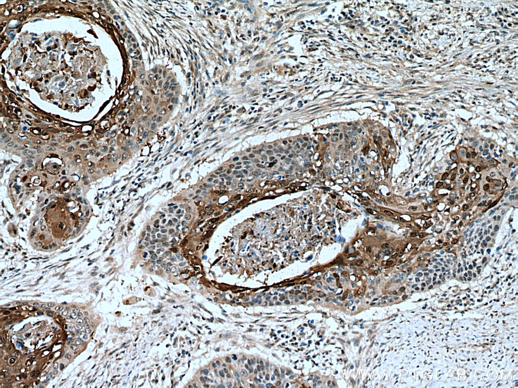 IHC staining of human oesophagus cancer using 24680-1-AP