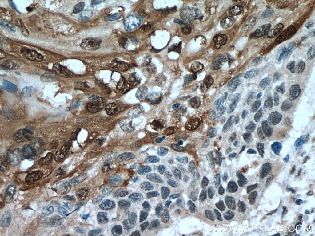 Immunohistochemistry (IHC) staining of human oesophagus cancer tissue using SPRR1A Polyclonal antibody (24680-1-AP)