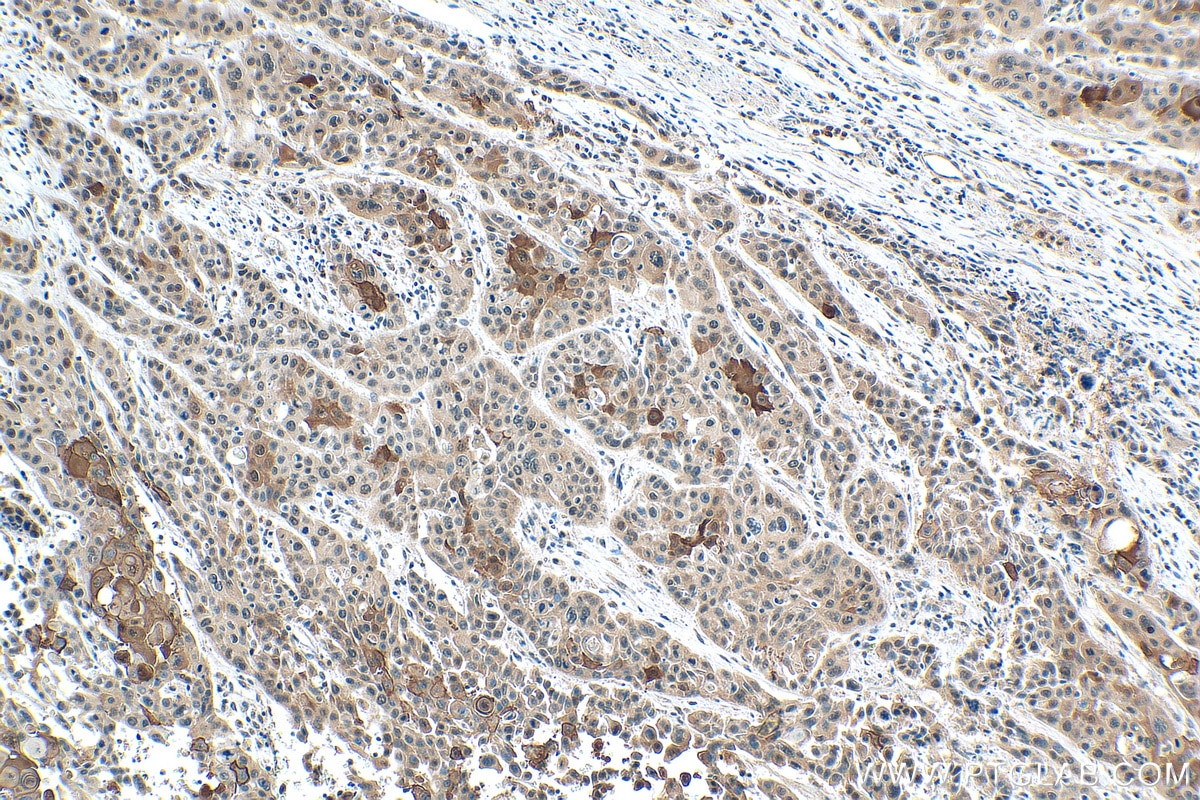 Immunohistochemistry (IHC) staining of human oesophagus cancer tissue using SPRR1A Polyclonal antibody (24680-1-AP)