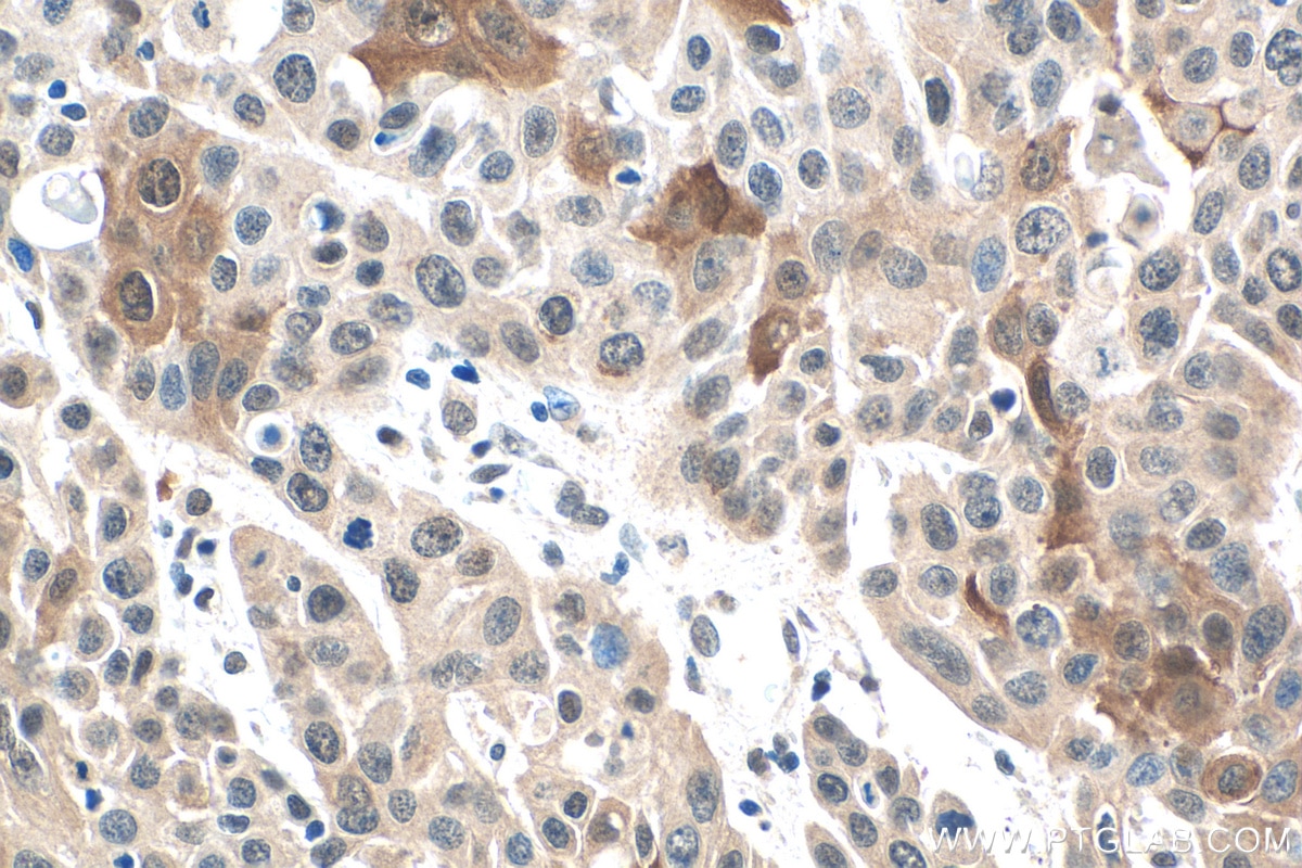 Immunohistochemistry (IHC) staining of human oesophagus cancer tissue using SPRR1A Polyclonal antibody (24680-1-AP)