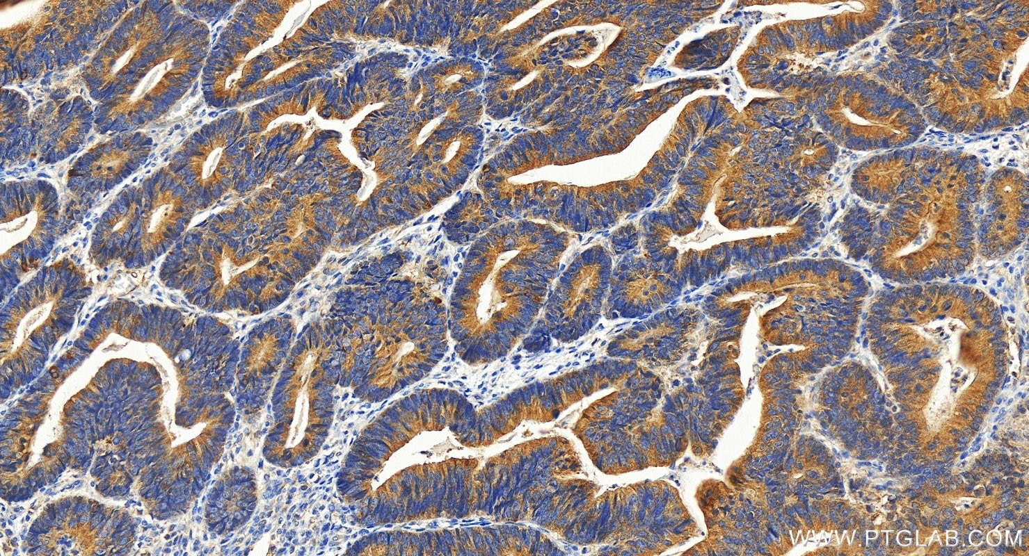 IHC staining of human colon cancer using 26135-1-AP (same clone as 26135-1-PBS) Immunohistochemistry (IHC) staining of human colon cancer tissue using SPRR2A Polyclonal antibody (26135-1-AP)