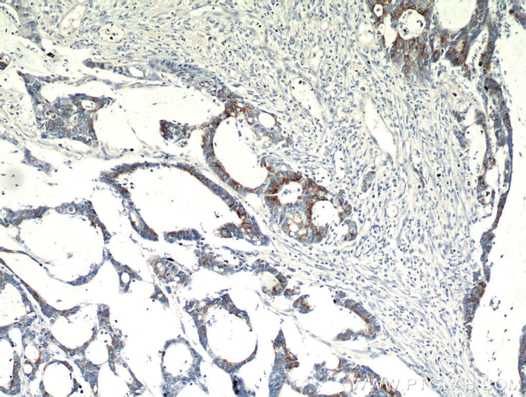 Immunohistochemistry (IHC) staining of human colon cancer tissue using SPRR3 Polyclonal antibody (11742-1-AP)