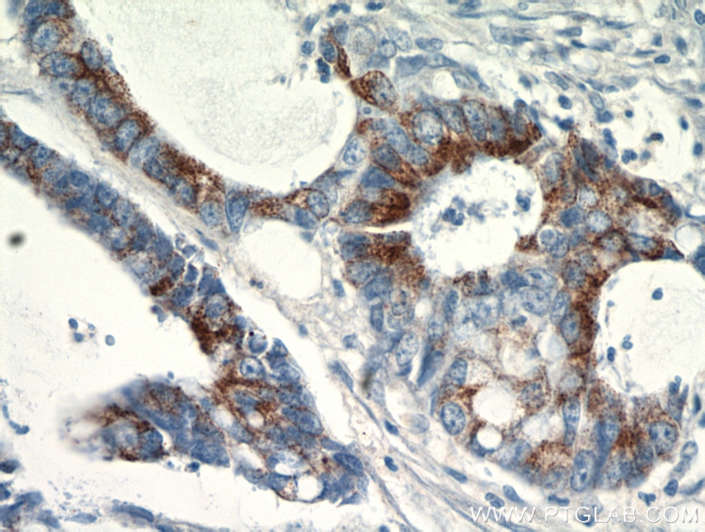 IHC staining of human colon cancer using 11742-1-AP