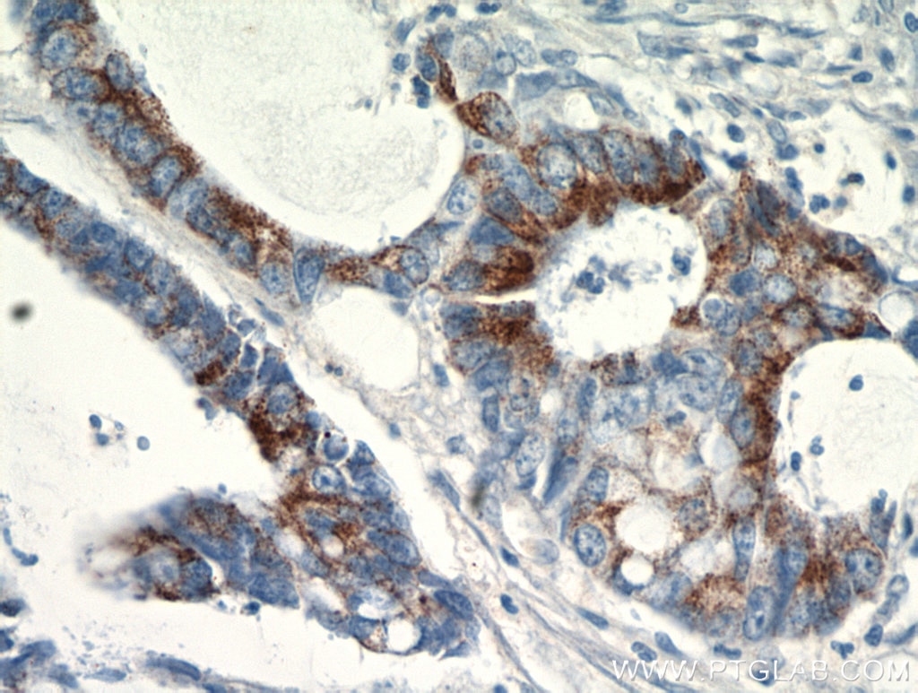 Immunohistochemistry (IHC) staining of human colon cancer tissue using SPRR3 Polyclonal antibody (11742-1-AP)