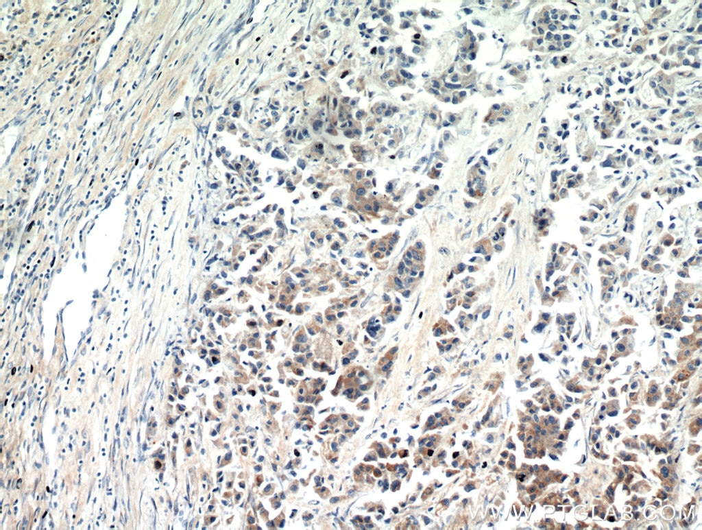 Immunohistochemistry (IHC) staining of human breast cancer tissue using SPRR3 Polyclonal antibody (11742-1-AP)