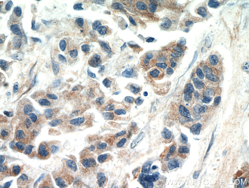 Immunohistochemistry (IHC) staining of human breast cancer tissue using SPRR3 Polyclonal antibody (11742-1-AP)