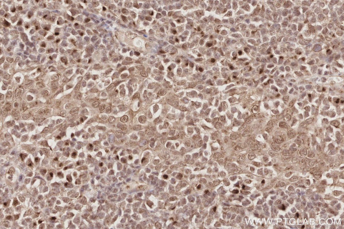 IHC staining of human tonsillitis using 24850-1-AP (same clone as 24850-1-PBS) Immunohistochemistry (IHC) staining of human tonsillitis tissue using Spartan Polyclonal antibody (24850-1-AP)