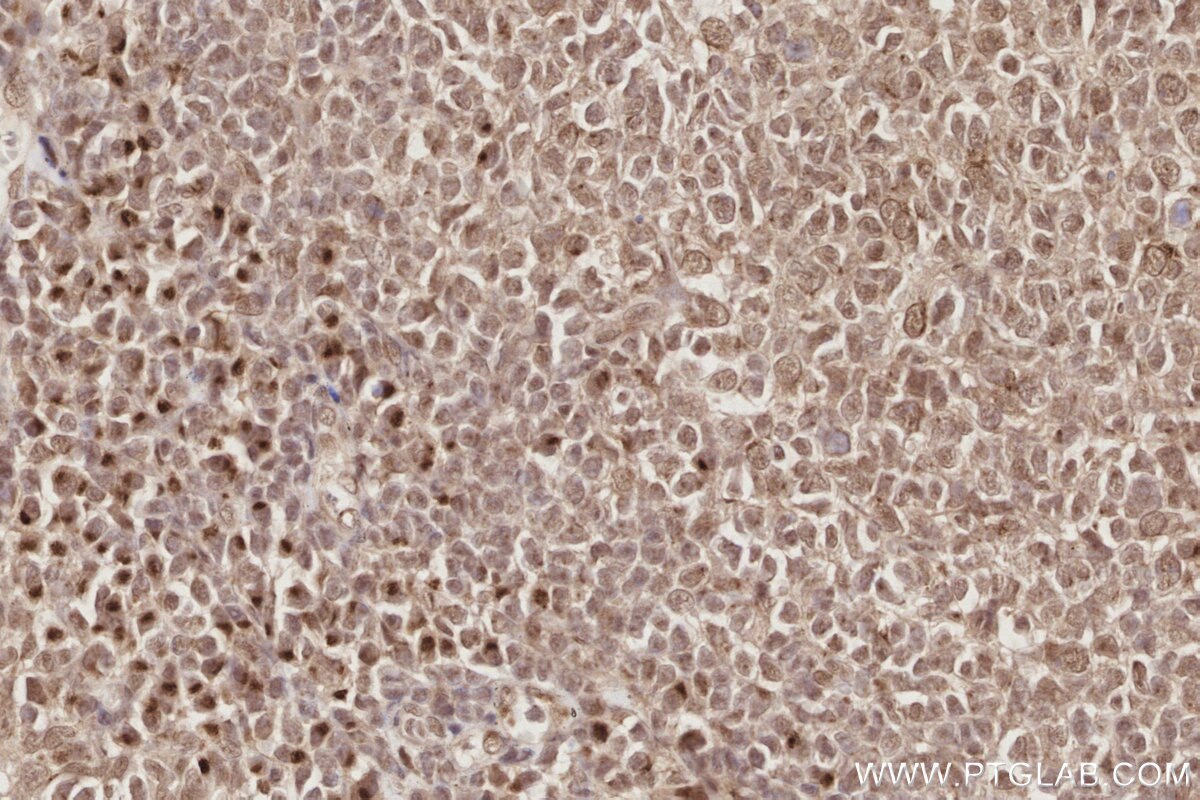 IHC staining of human tonsillitis using 24850-1-AP (same clone as 24850-1-PBS) Immunohistochemistry (IHC) staining of human tonsillitis tissue using Spartan Polyclonal antibody (24850-1-AP)