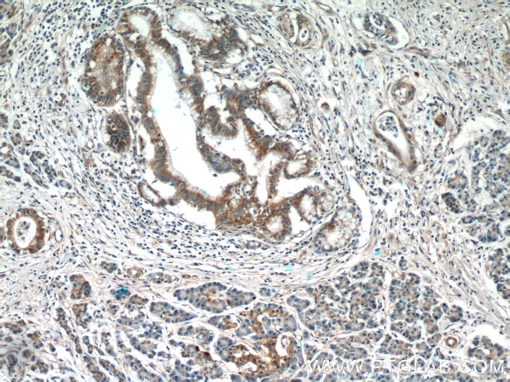 Immunohistochemistry (IHC) staining of human pancreas cancer tissue using SPRY2 Polyclonal antibody (11383-1-AP)