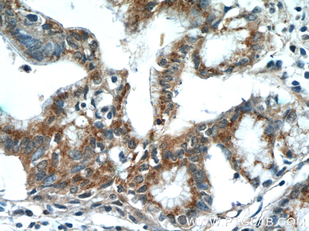 Immunohistochemistry (IHC) staining of human pancreas cancer tissue using SPRY2 Polyclonal antibody (11383-1-AP)