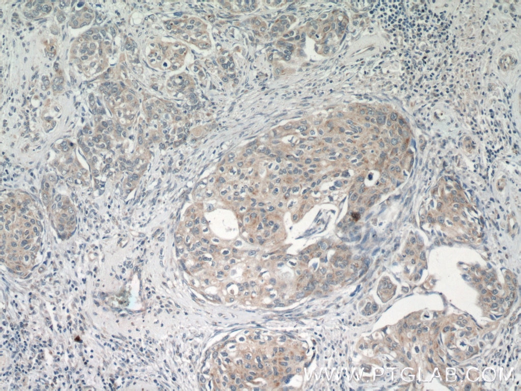 Immunohistochemistry (IHC) staining of human cervical cancer tissue using SPRY4 Polyclonal antibody (22765-1-AP)