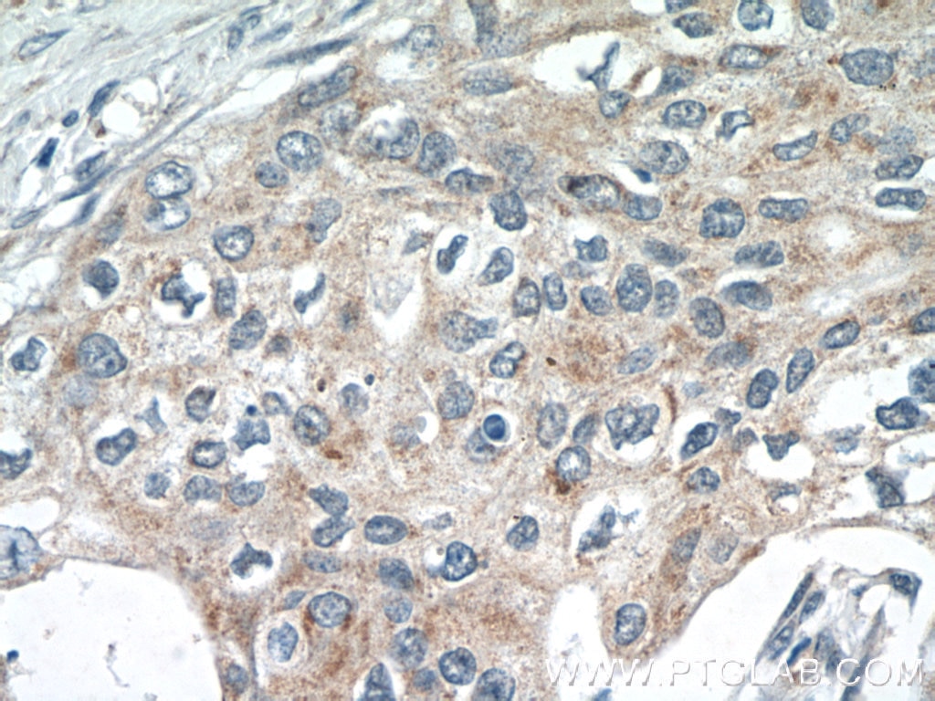Immunohistochemistry (IHC) staining of human cervical cancer tissue using SPRY4 Polyclonal antibody (22765-1-AP)