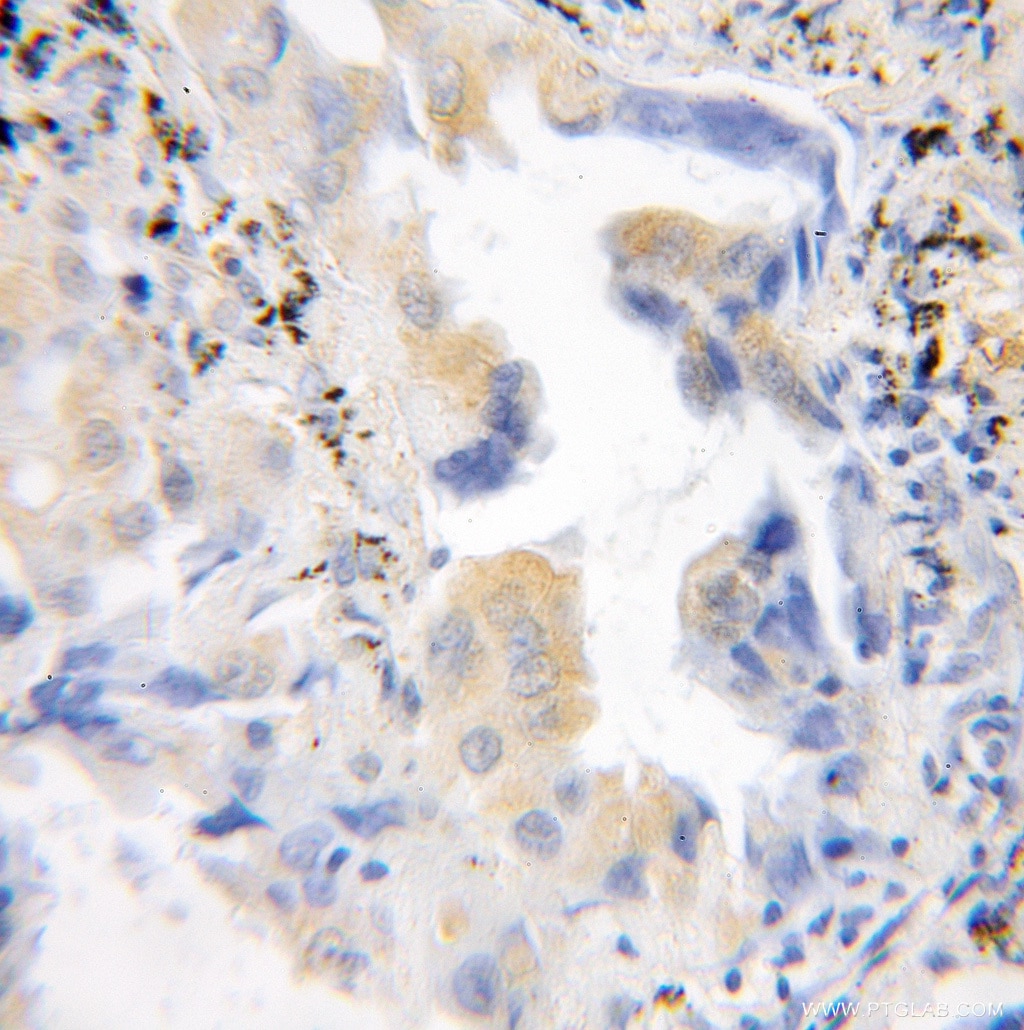 Immunohistochemistry (IHC) staining of human lung cancer tissue using SPSB1 Polyclonal antibody (12194-1-AP)