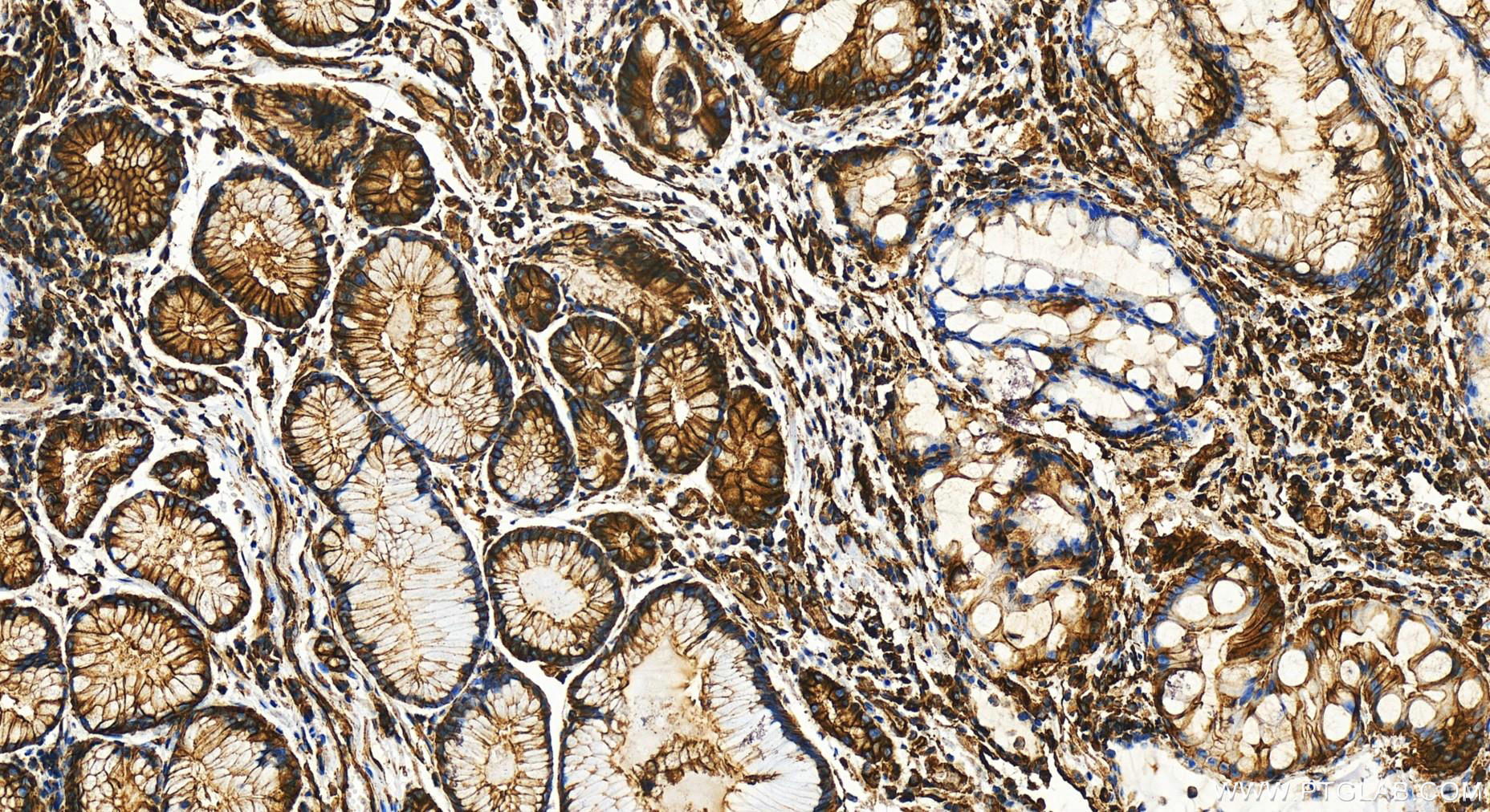 Immunohistochemistry (IHC) staining of human stomach cancer tissue using SPTAN1 Polyclonal antibody (31676-1-AP)
