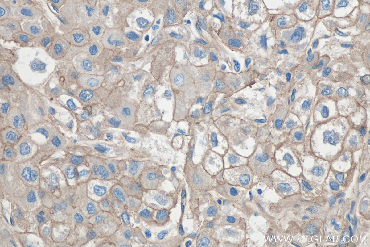 Immunohistochemistry (IHC) staining of human liver cancer tissue using SPTBN1 Monoclonal antibody (67978-1-Ig)