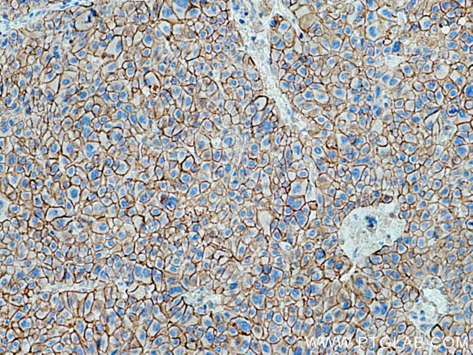 Immunohistochemistry (IHC) staining of human liver cancer tissue using SPTBN1-Specific Polyclonal antibody (19722-1-AP)