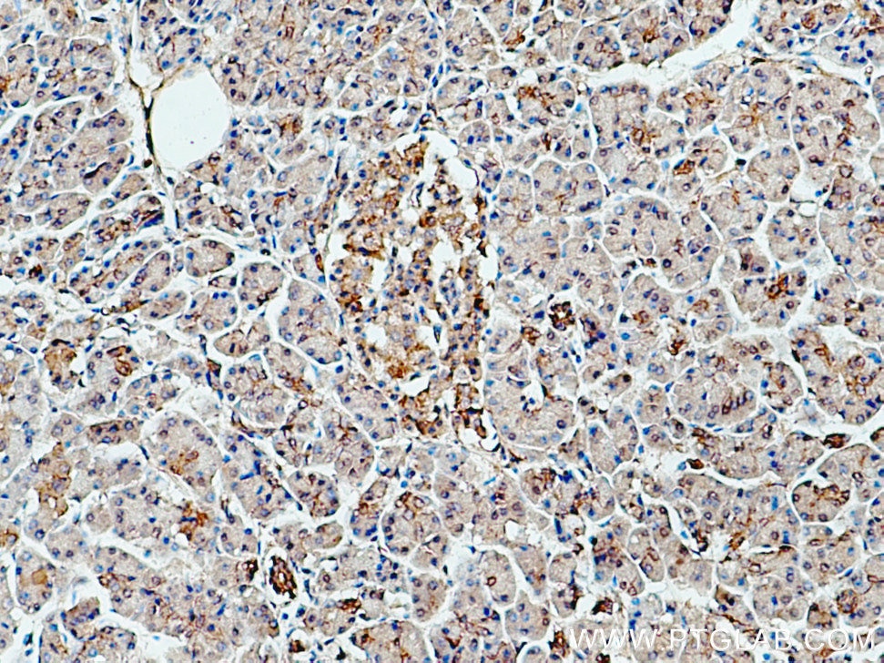 Immunohistochemistry (IHC) staining of human pancreas cancer tissue using SPTBN1-Specific Polyclonal antibody (19722-1-AP)