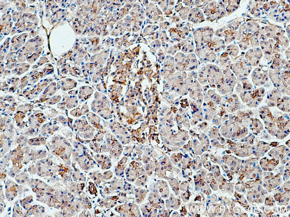 IHC staining of human pancreas cancer using 19722-1-AP