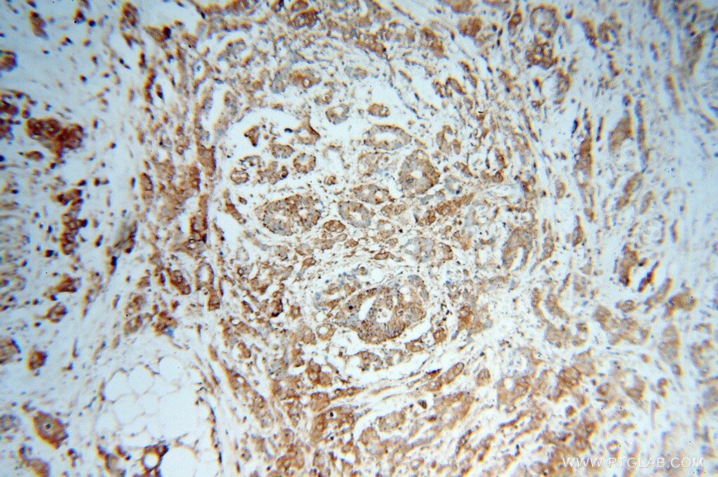 Immunohistochemistry (IHC) staining of human colon cancer tissue using SPTLC1 Polyclonal antibody (15376-1-AP)