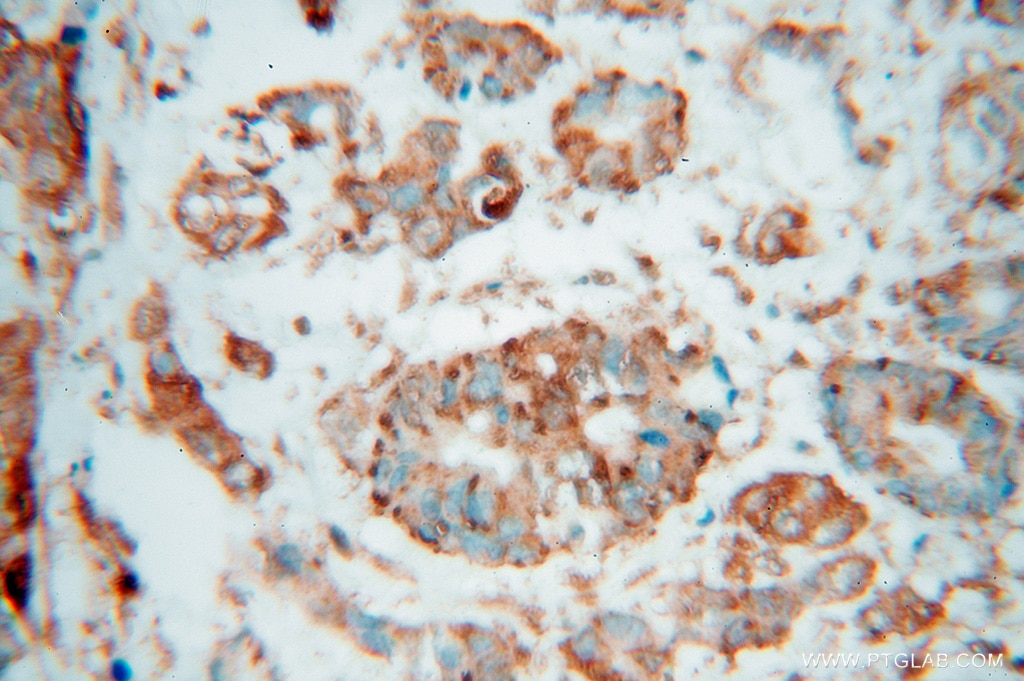 Immunohistochemistry (IHC) staining of human colon cancer tissue using SPTLC1 Polyclonal antibody (15376-1-AP)