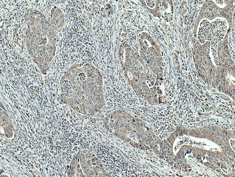 Immunohistochemistry (IHC) staining of human colon cancer tissue using SPTLC1 Monoclonal antibody (66899-1-Ig)