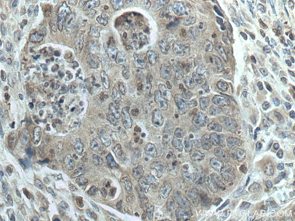 IHC staining of human colon cancer using 66899-1-Ig